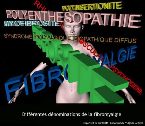 Differentes denominations de la fibromyalgie